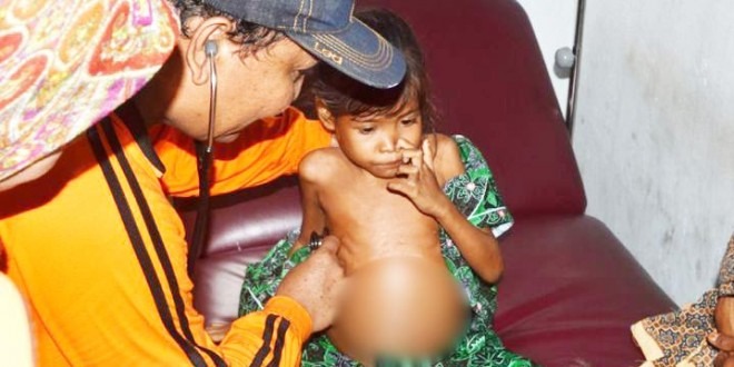 Atasi Masalah Gizi Buruk